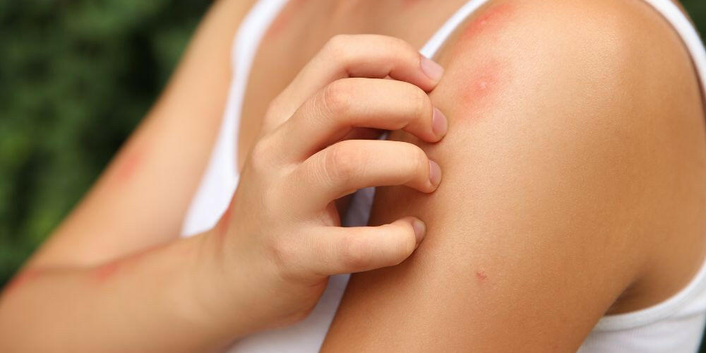 Quali sono i migliori rimedi contro le zanzare?
